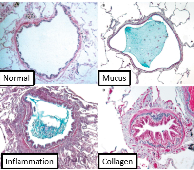 <p>Small bronchi + bronchioles (&lt;2mm diameter) = main obstruction sites for COPD</p><p>Airflow limitation:</p><ul><li><p>Thickening walls</p></li><li><p>Reduction lumen</p></li></ul><p></p>