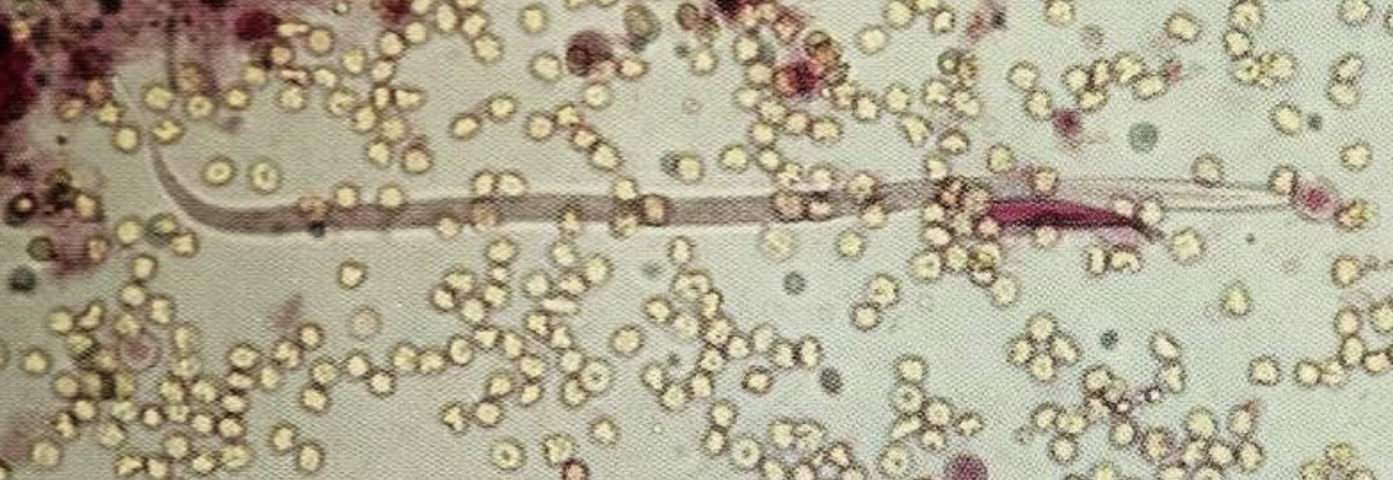 <p>What parasitic worm is this?</p><p>What is surrounding it?</p><p>When would you see it in urine?</p>