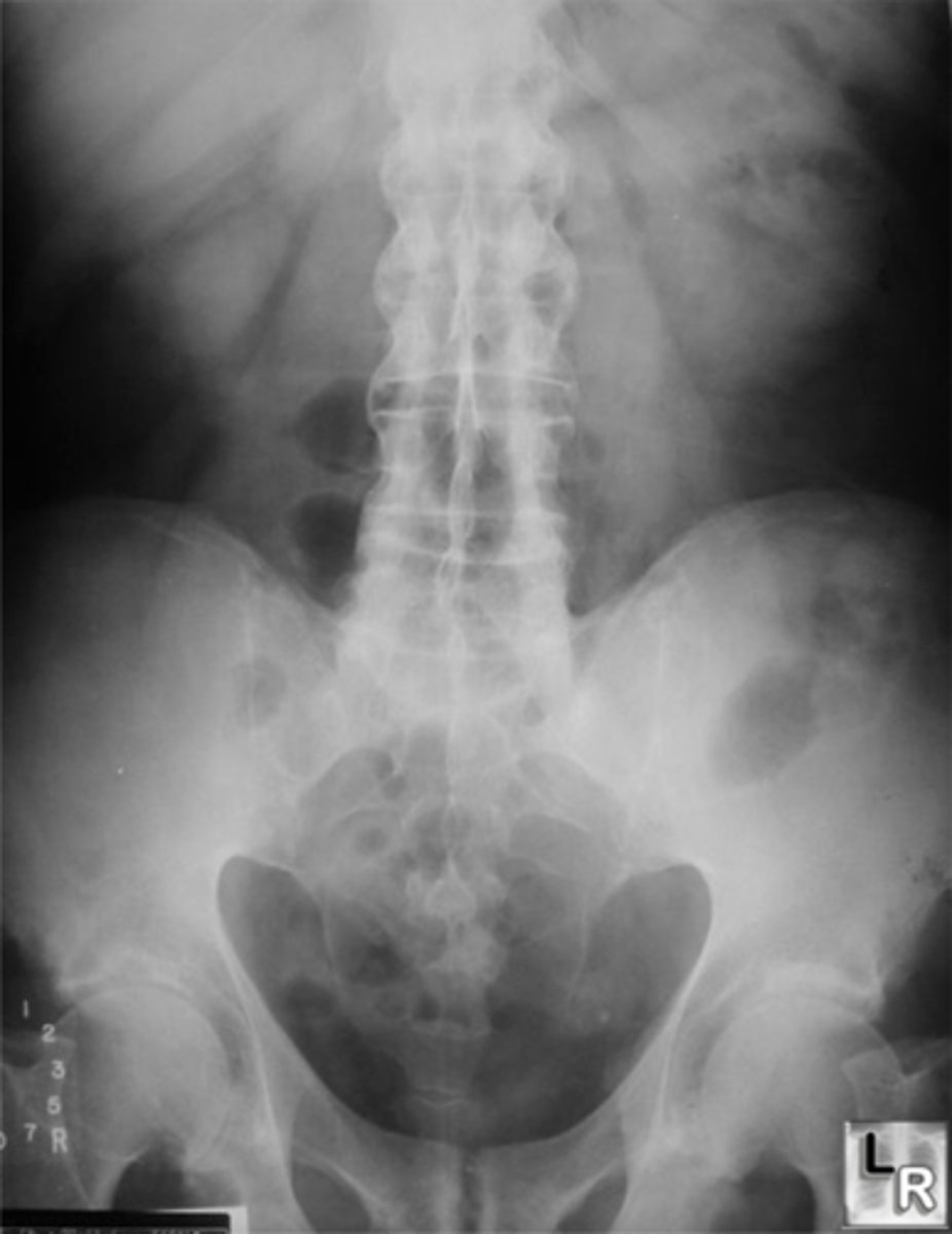 <p>Vignette # 21</p><p>Sex: Male</p><p>Age: 22</p><p>Chief Complaint: Patient presents with insidious onset of low back pain and sacroiliac pain. He also reports having gastrointestinal issues.</p><p>Objective Findings: Forrestier's sign +, Chest expansion 1.25" Diagnostic imaging: X-ray</p><p>1. What are the radiographic signs expected in this condition? (Choose 3)</p><p>a. Shiny corner</p><p>b. Trolley track</p><p>c. Hiatal hernia</p><p>d. Unilateral SI sclerosis</p><p>e. Chondral sclerosis</p><p>f. Overhanging edge sign</p><p>g. Non-marginal syndesmophytes</p><p>h. Dagger sign</p>