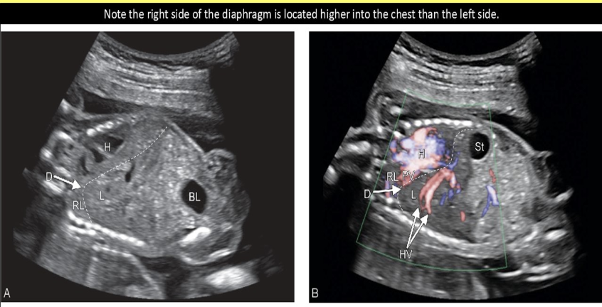 <p><strong>muscle weakness </strong>of the fetal <strong>diaphragm</strong> that mimic the appearance of a hernia is called</p><p>a) diaphragmatic eventration</p><p>b) hydrothorax</p><p>c) chylothorax</p><p>d) diaphragmatic</p>