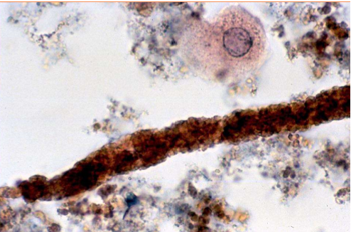 <p>What type of cast is present?</p>
