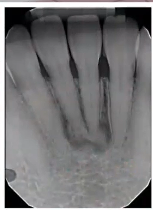 <p>dx: </p><p>osteoblastoma </p><p>bone scar </p><p>osteoma </p><p>periapical cemento-osseous dysplasia </p>