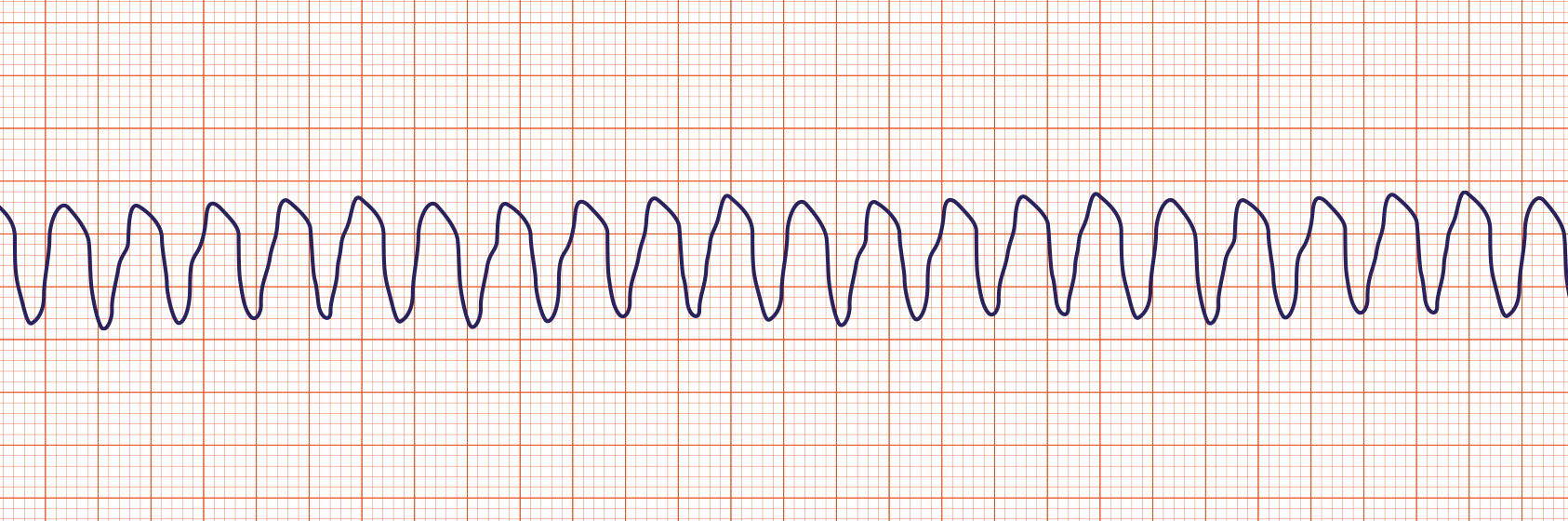 <p><span>Ventricular tachycardia (Vtach or VT) is characterized by bizarre widened QRS complexes, no P waves and usually a rate over 100 per minute. May quickly degenerate to Ventricular fibrillation and death. VT may be responsive to electrical defibrillation.</span></p>