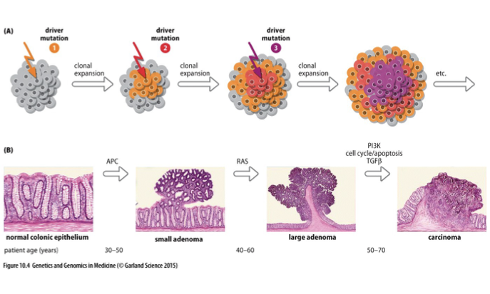 <p>The process by which cancer develops through multiple genetic alterations over time, leading to progressively more aggressive tumor phenotypes. </p>
