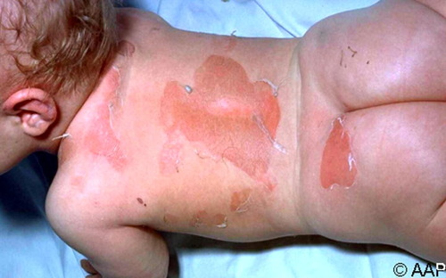 <p>-Production of exfoliative toxins that cause erythema (redness of skin) and epidermal desquamation at remote sites from staphylococcal infection<br>-Most common in neonates and children <5yr<br>-no scar since only epidermis</p>