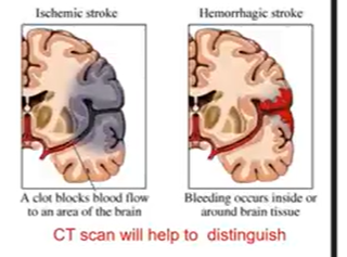 <p>Sudden loss of brain function from X blood supply to part of brain</p><ul><li><p>Ischemic: clot blockage → vO2; thrombotic/embolic</p><ul><li><p>Thrombotic: Thrombus ← arterial occlusion ← brain vessel blood clot</p><ul><li><p>TIA: clots causes intermittent blockage (24 hrs)</p></li></ul></li><li><p>Embolic: clot travels TO brain → blocks brain supply</p></li></ul></li><li><p>Hemorrhagic: bleeding inside or around (cerebral artery)</p><ul><li><p>C/x: HTN, ruptured aneurysm</p></li></ul></li><li><p>r/x:</p><ul><li><p>age, sex, genes, race</p></li><li><p>HTN, Hyperlipidemia, Smoking, ETOH, DM, a-fib, obese, cocaine</p></li></ul></li></ul><p></p><p>Stroke s/s:</p><ul><li><p>Hemiparesis, hemisensory loss</p></li><li><p>LOC, Headache, slurred speech</p></li><li><p>ALWAYS OPP SIDE OF BODY</p></li></ul><p></p>