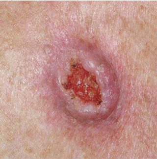 Squamous cell carcinoma