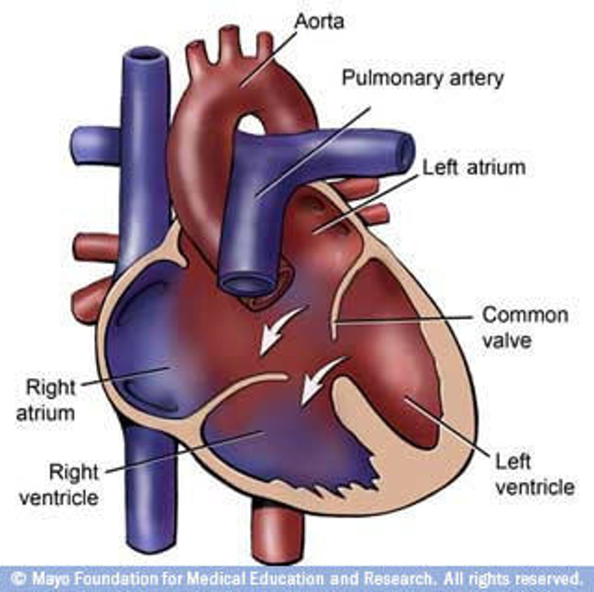 <p>Large hole in the center of the heart, common with Down Syndrome</p><p>- blood MIXES = volume overload on BOTH sides</p><p>- early HF symptoms (poor feeding, tachypnea)</p><p>- RAPID HF progression</p>