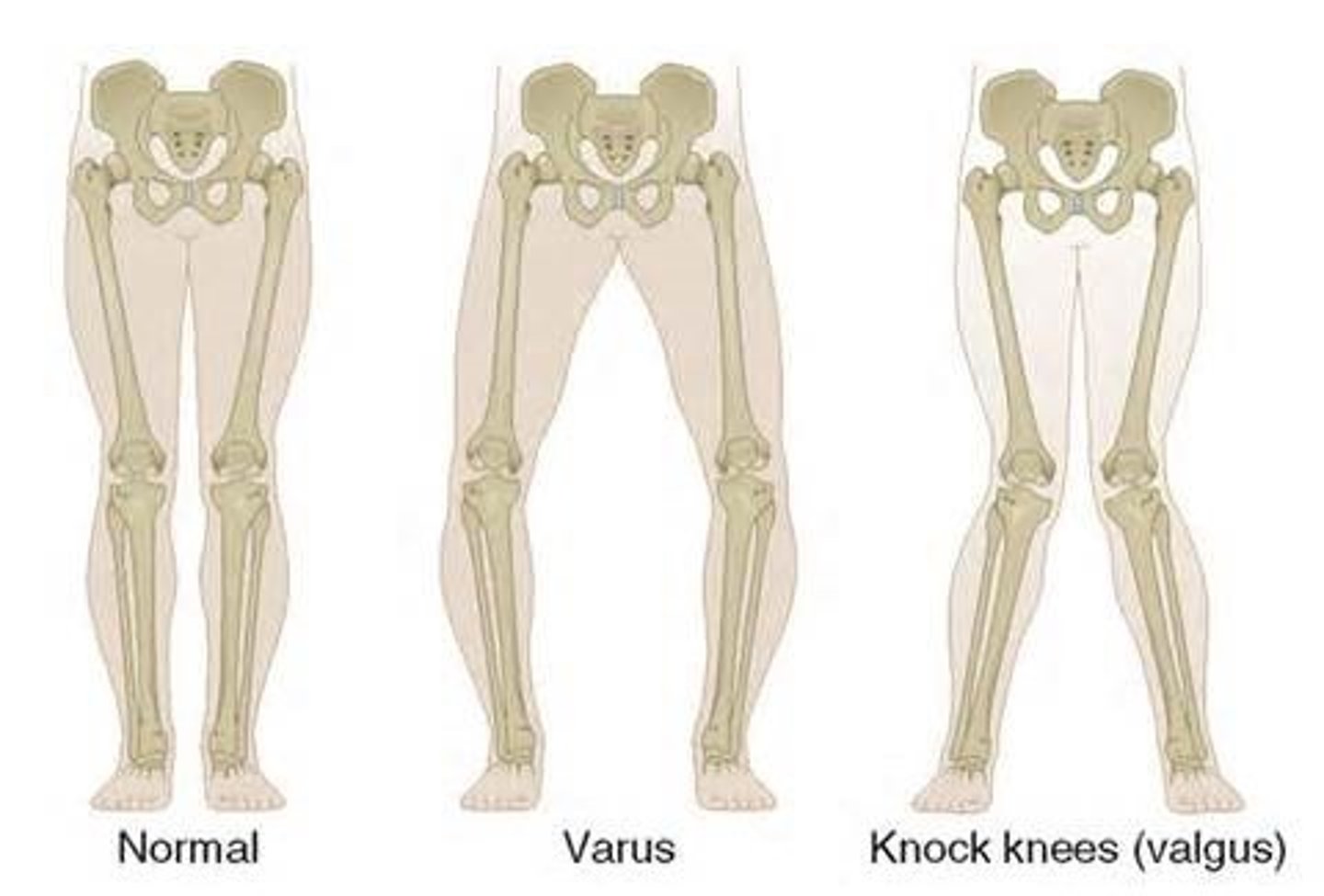 <p>varus → R like riding a horse</p><p>valgus is knock knee</p>