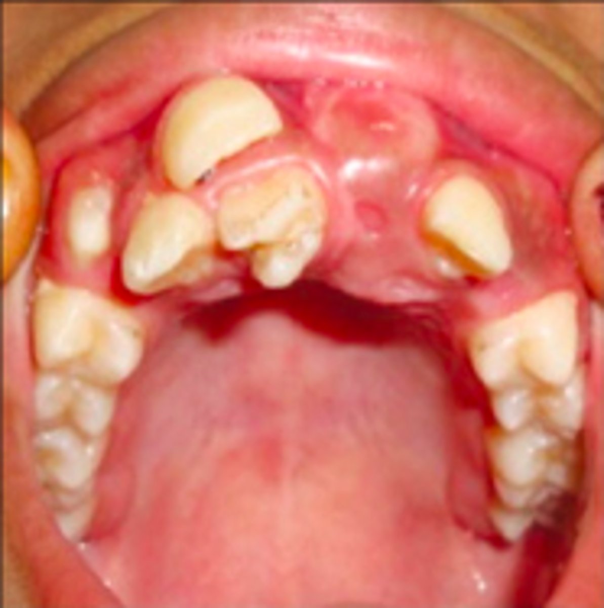 <p>Hyperdontia can be a sign and associated with what GI condition?</p>