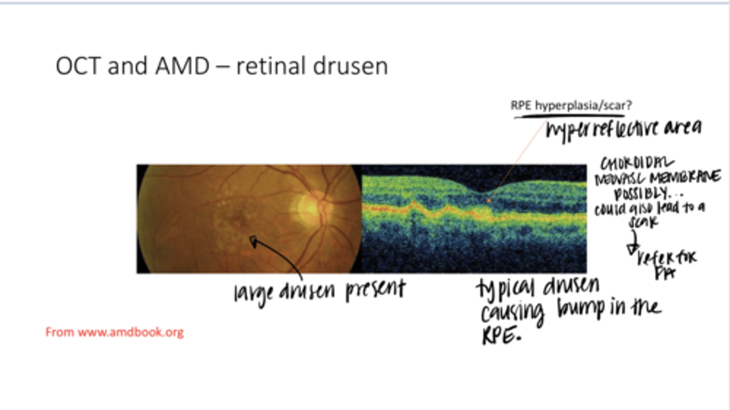 <p>If you see a scar in the macula of an AMD patient, what should you do about it?</p>
