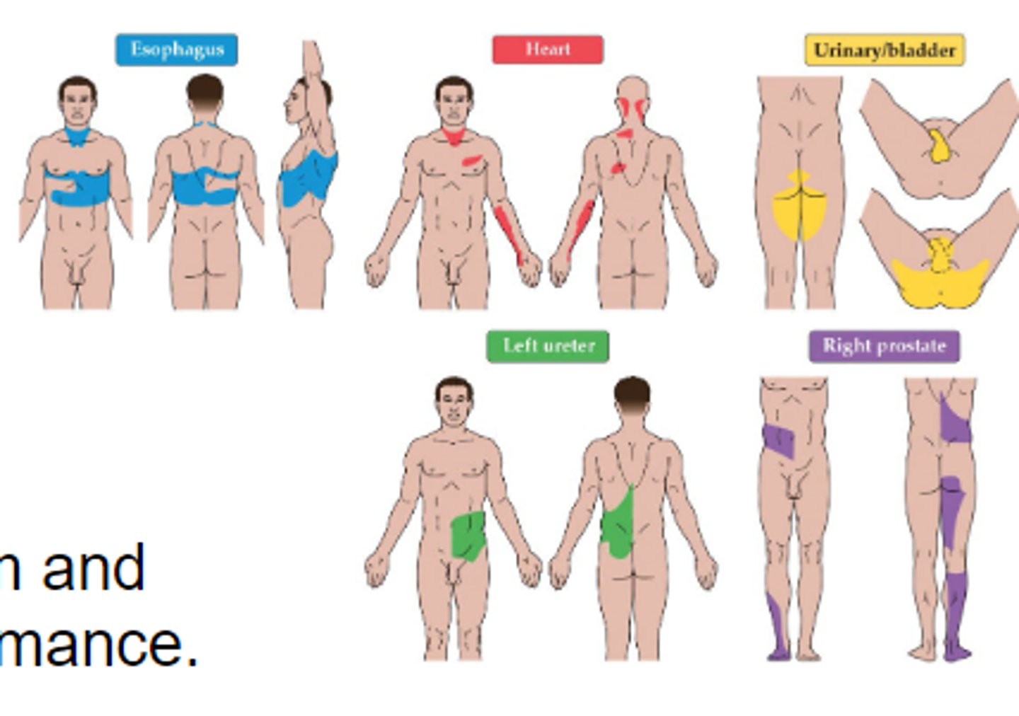<p>Damage/issue w/ an internal organ results in specific sensations of pain across the body. Caused by visceral nociception (from organs) mixing w/ cutaneous nociception</p>