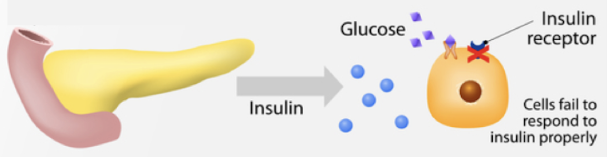 <ul><li><p><span>caused by insulin resistance and relative deficiency where insulin produced by the body is not used effectively&nbsp;</span></p></li></ul><p></p>