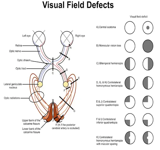 <ul><li><p><span>Q: What types of visual field defects do visual cortex pathologies produce?</span></p></li><li><p><span> A: Congruous VF defects (hemianopias, keyhole defects, macular sparing)</span></p></li></ul><p></p><ul><li><p><span>Q: What are common causes of visual cortex pathologies?</span></p></li><li><p><span> A: Vascular lesions, trauma, tumors</span></p></li></ul><p></p>