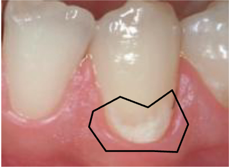<p>White spot lesion</p><p>The enamel is dissolving, more pores of the tooth are exposed</p>