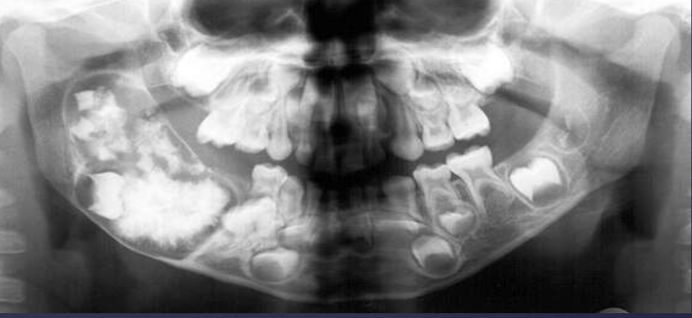 <ol><li><p>mixed density, corticated </p></li><li><p>combination of amorphous radiopaque mass + tooth-like structures</p></li></ol><p></p>