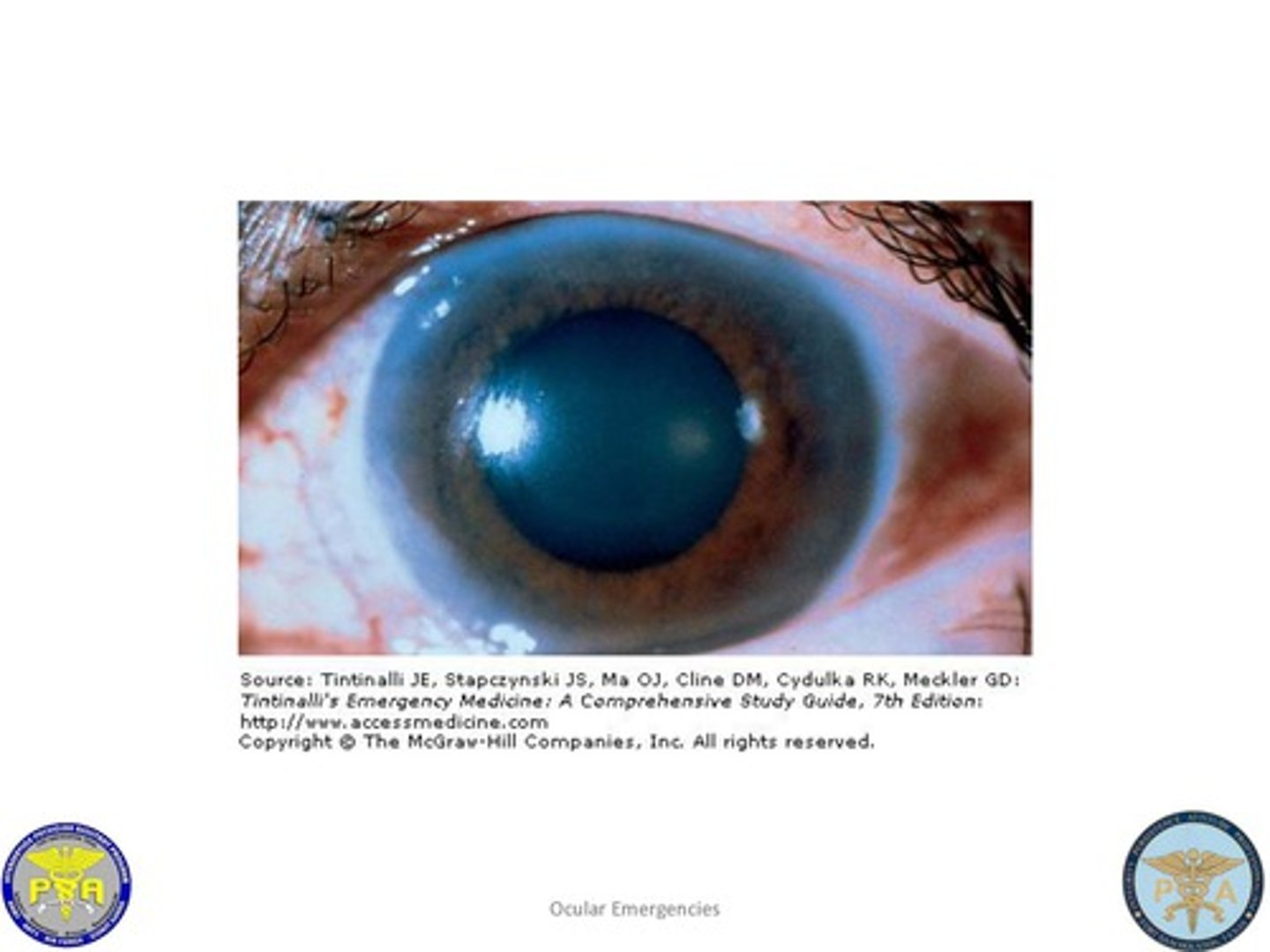 <p><u>Etio</u>: caused by obstruction to drainage of aqueous humor, preventable blindness;  almost always follows a lesion of anterior eye segment</p><p><u>Risk Factors</u>: drugs, some medications, cocaine, <strong><mark data-color="#fffb02" style="background-color: #fffb02; color: inherit">cocaine,</mark></strong><mark data-color="#fffb02" style="background-color: #fffb02; color: inherit"> </mark><strong><mark data-color="#fffb02" style="background-color: #fffb02; color: inherit">ecstasy</mark>,</strong> trauma</p><p><u>S&amp;S</u>: sudden onset of severe pain, <strong><mark data-color="#fdff00" style="background-color: #fdff00; color: inherit">steamy cornea</mark></strong><mark data-color="#fdff00" style="background-color: #fdff00; color: inherit">,</mark> fixed mid-dilated pupil, halos, blurred vision, nausea/vomiting, <strong><mark data-color="#fff500" style="background-color: #fff500; color: inherit">shallow anterior chamber</mark></strong></p><p><u>Testing</u>: IOP &gt; 22</p><p><u>Tx</u>: <strong><mark data-color="#fffb00" style="background-color: #fffb00; color: inherit">Timolol 0.5%</mark>, </strong>emergent consult to ophtho </p>