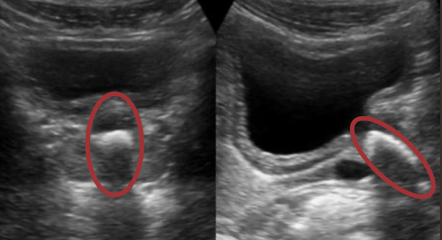 <ul><li><p><span style="color: yellow;">small, membranous canal that excretes urine from urinary bladder</span></p><ul><li><p>contains internal and external sphincters</p></li></ul></li><li><p><u>male</u> urethra: <mark data-color="yellow" style="background-color: yellow; color: inherit;">~20 cm</mark> long</p><ul><li><p>male has 3 parts: prostatic, membranous, and penile urethra</p></li></ul></li><li><p><u>female</u> urethra: <mark data-color="yellow" style="background-color: yellow; color: inherit;">~3.5 cm</mark> long</p></li><li><p>SONO: not routinely visualized (but image shows where it would be)</p></li></ul><p></p>