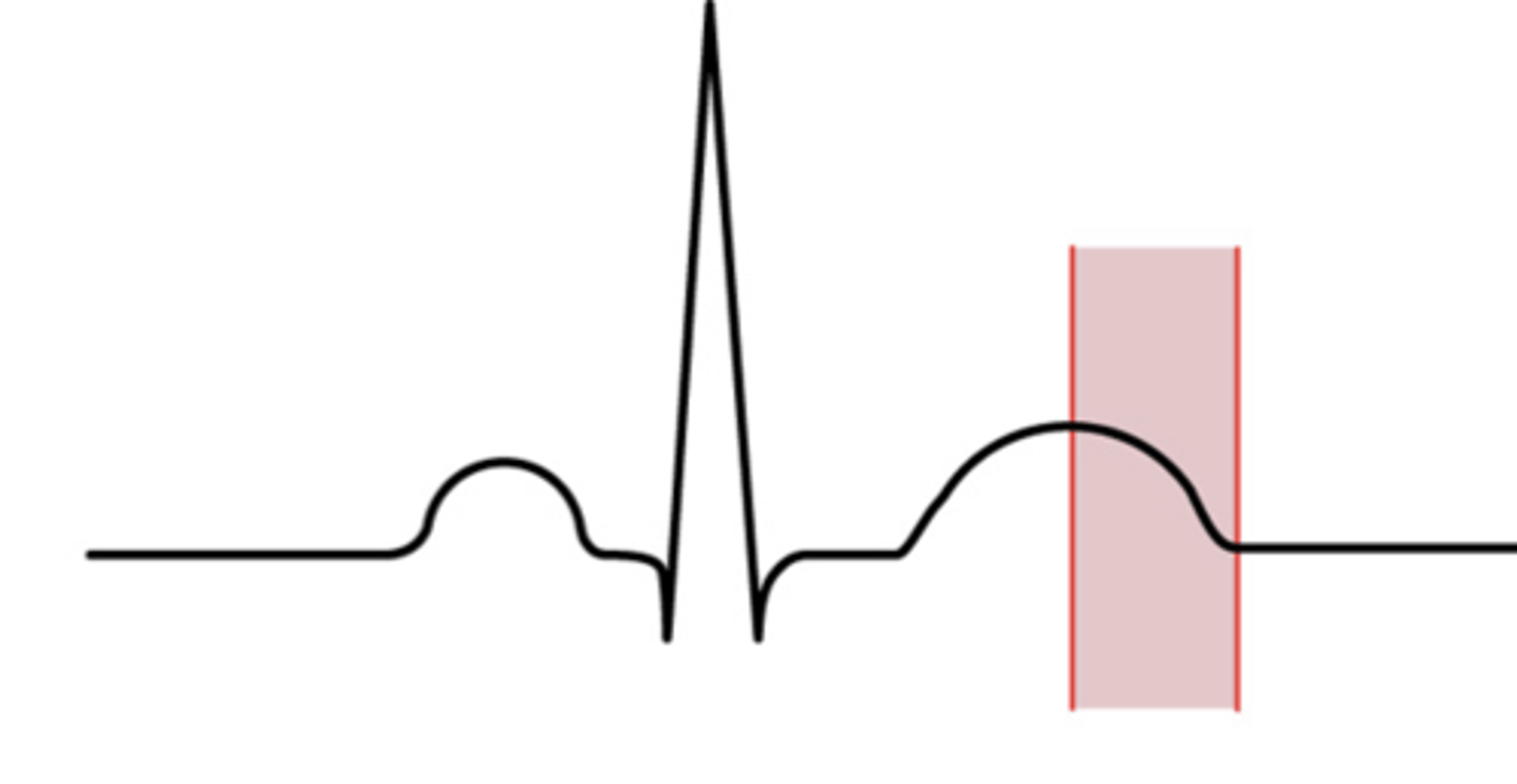 <p>from the middle of the T-wave to the end of the T-wave; A strong enough outside stimulus can initiate depolarization of the only partially recharged cells.</p>
