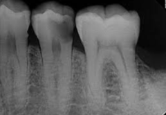 <p>excessive gross decay&nbsp;</p>