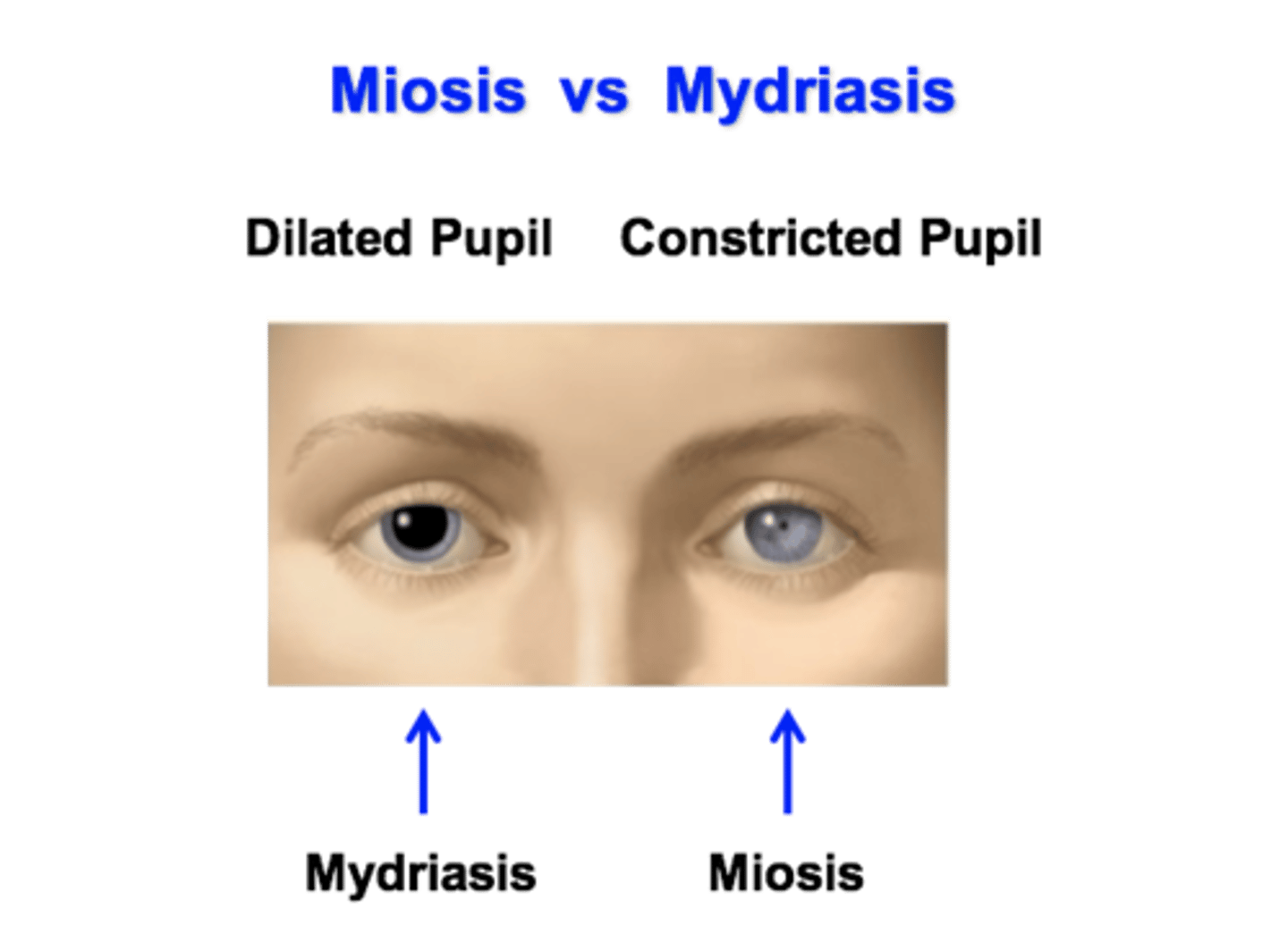 <p>Pupil dilation by contraction of radial/ dilator muscle (iris smooth muscle).</p><p>- This is sympathetic innervation of the iris</p>
