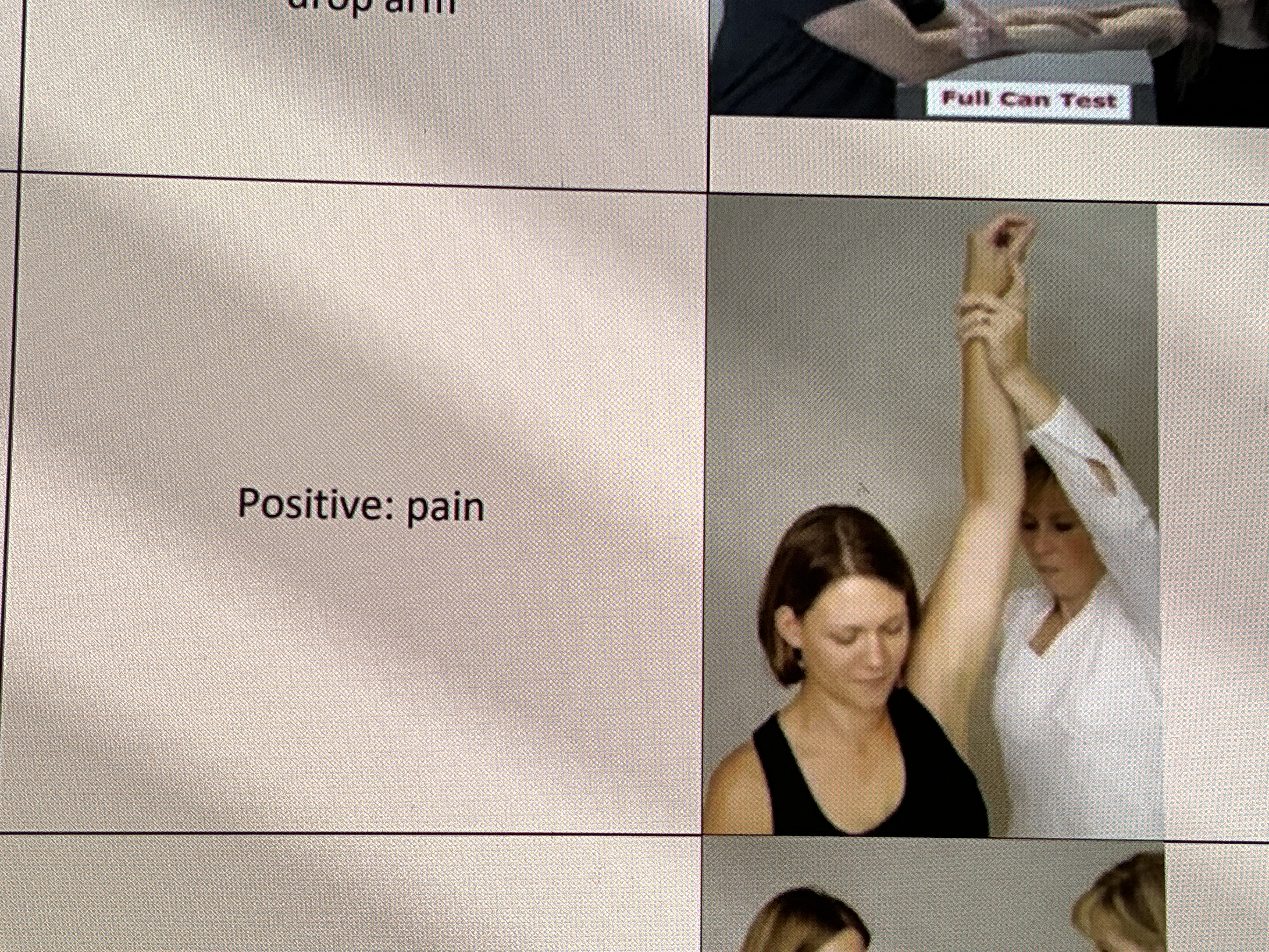 <p><strong>Indication: </strong>To assess for subacromial impingement syndrome (acromion &amp; head of humerus).(GBK is wrong with overuse injury to the supraspinatus tendon).​</p><p><strong>Steps:</strong> ​</p><ol><li><p>The client is in a seated position or standing. ​</p></li><li><p>The therapist stands behind or beside the client​</p></li><li><p>The therapist passively internally rotates the affected arm and forward flexes the shoulder until the end​</p></li></ol><p><strong>Pain at the shoulder joint indicates a positive test.</strong>​</p><p></p>