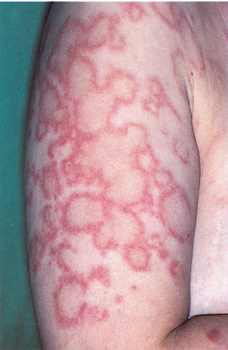 <p>small, erythematous, slightly scaly papules that evolve into psoriasiform plaques or annular plaques→seen on shoulders, forearms, neck and upper torso</p>