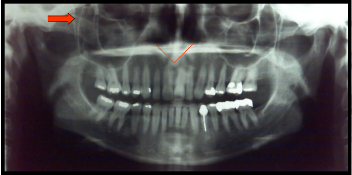 <ul><li><p><span>Appears as a V-shaped radiopaque area located at the intersection of the floor of the nasal fossa and the nasal septum.</span></p></li><li><p><span>Appears as a radiolucent area between the lateral pterygoid plate and the maxilla.</span></p></li></ul><p></p>