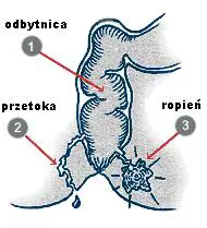 <p>drenaż chirurgiczny</p><p>antybiotykoterapia → w powikłaniach i w chorobach towarzyszących np cukrzycy i w rozległym zapaleniu tkanki podskórnej</p><p>pozostająca pod duzym cisnieniem treść ropna może spowodować powstanie przetoki okołoodbytniczej</p><p>trzykrotnie częstsze u mężczyzn</p>