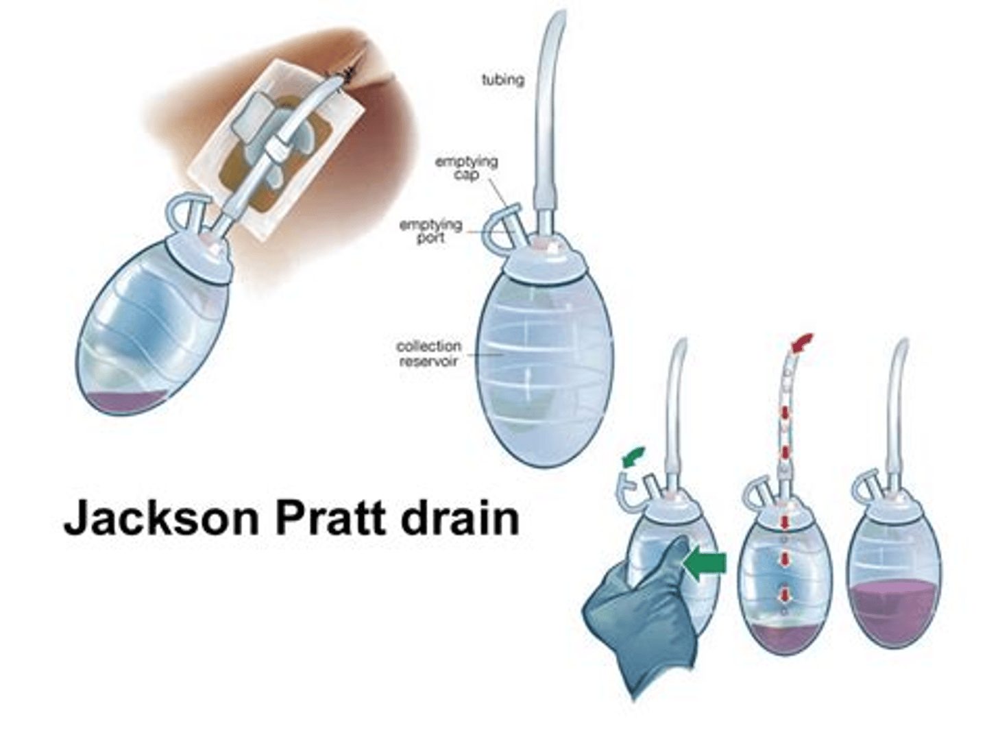 <p>-<strong>preferred</strong> type</p><p>-connected to a suction device</p><p>-Jackson-Pratt and Blake drains</p>