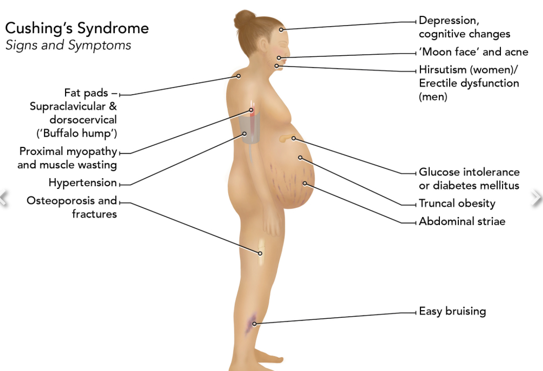 <ul><li><p>Proximal myopathy</p></li><li><p>Buffalo hump </p></li><li><p>Striae and easy bruising on abdomen </p></li><li><p>Osteoporosis and fractures </p></li><li><p>Obesity </p></li><li><p>HTN</p></li><li><p>Hyperkalaemia </p></li><li><p>Hirsutism </p></li><li><p>Erectile dysfunction</p></li><li><p>Psychological issues </p></li></ul><p></p>