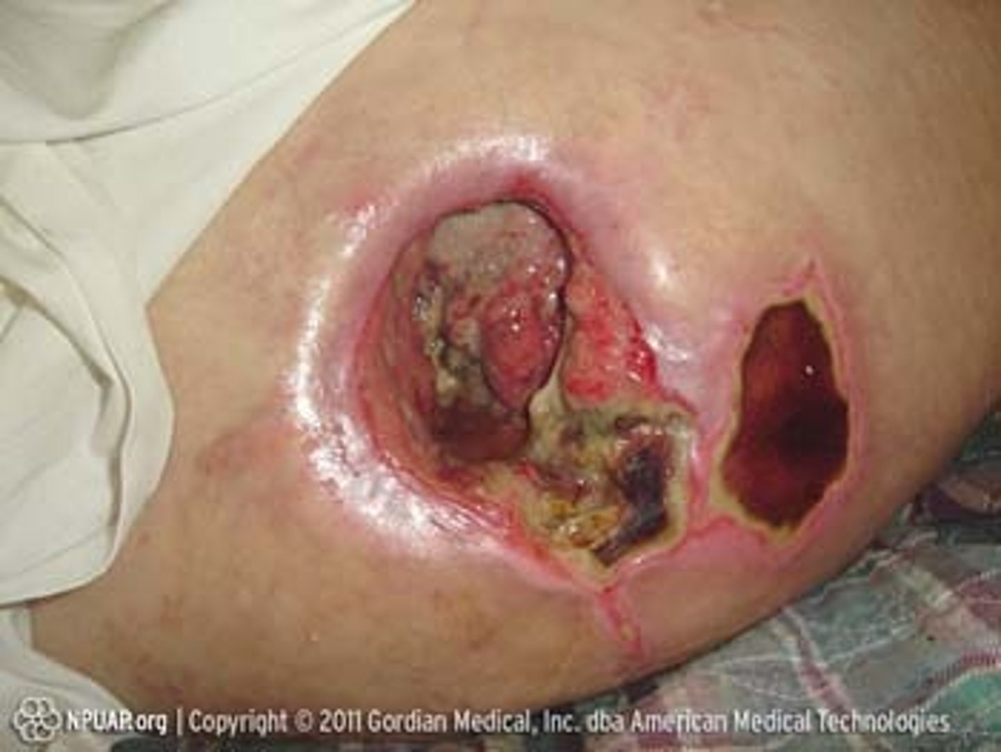 <p>Full-thickness tissue loss with exposed bone, muscle, or tendon</p>