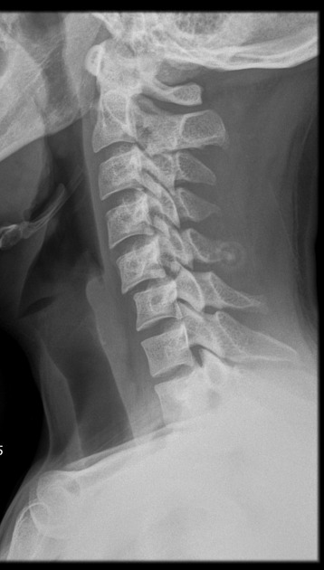 <p>unilateral subluxation of facet</p>