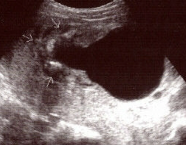 <ul><li><p>Thick walled bladder</p></li><li><p>Dilated posterior urethra</p></li><li><p><span style="color: rgb(231, 0, 0);"><strong>keyhole sign</strong></span></p></li><li><p>hydrureter</p></li><li><p>hydronephrosis</p></li><li><p>oligohydramnios</p></li><li><p>hypoplastic lungs</p></li></ul><p></p>