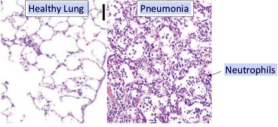 <p><span>1. Bacteria get into alveoli -&gt; immune system is activated</span><br><span>2. Neutrophils come in to battle bacteria</span><br><span>3. Cytokines are released (fever, chills, fatigue)</span><br><span>4. Neutrophils, bacteria, exudate, fluid fill the alveoli (poor gas exchange, hard to breathe)</span></p>