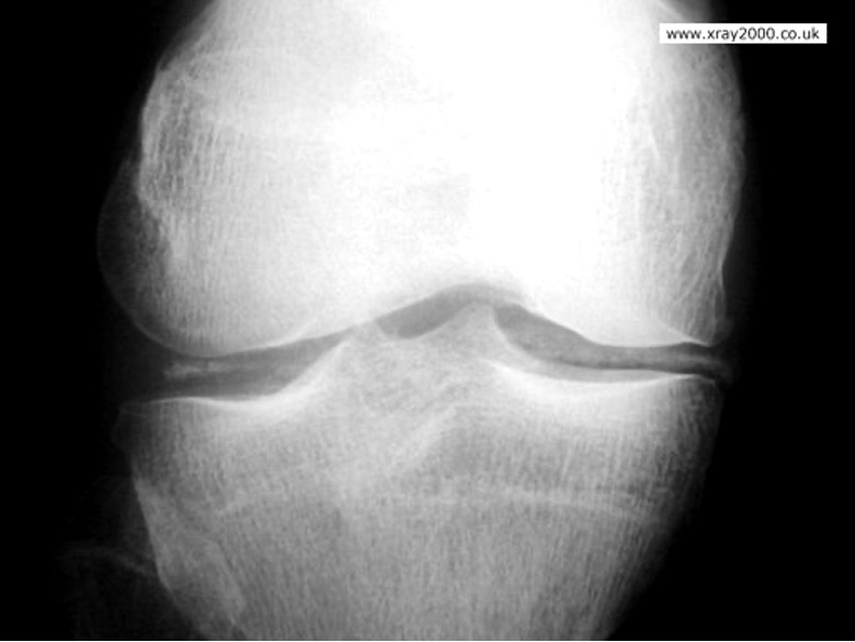 <p>calcification of articular cartilage</p>