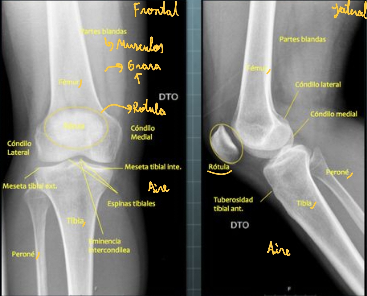 <ul><li><p>La rotula se aprecia mejor en forma lateral  </p></li></ul><p></p>