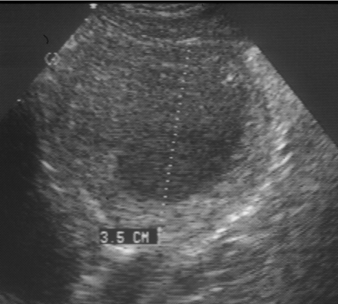 <ul><li><p>Appears multiloculated (multiple chambers)</p></li><li><p>Flocculant (cloudy), anechoic (black) fluid</p></li><li><p>Large hyperechoic capsule</p></li></ul><p></p>