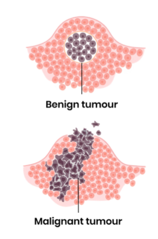 <ul><li><p>mutations in DNA / genes controlling mitosis can lead to uncontrolled cell division </p></li><li><p>Tumour formed if this results in mass of abnormal cells </p></li><li><p>→ malignant tumour = cancerous, can spread by metastasis</p></li><li><p>Benign tumour = non-cancerous</p></li></ul><p></p>