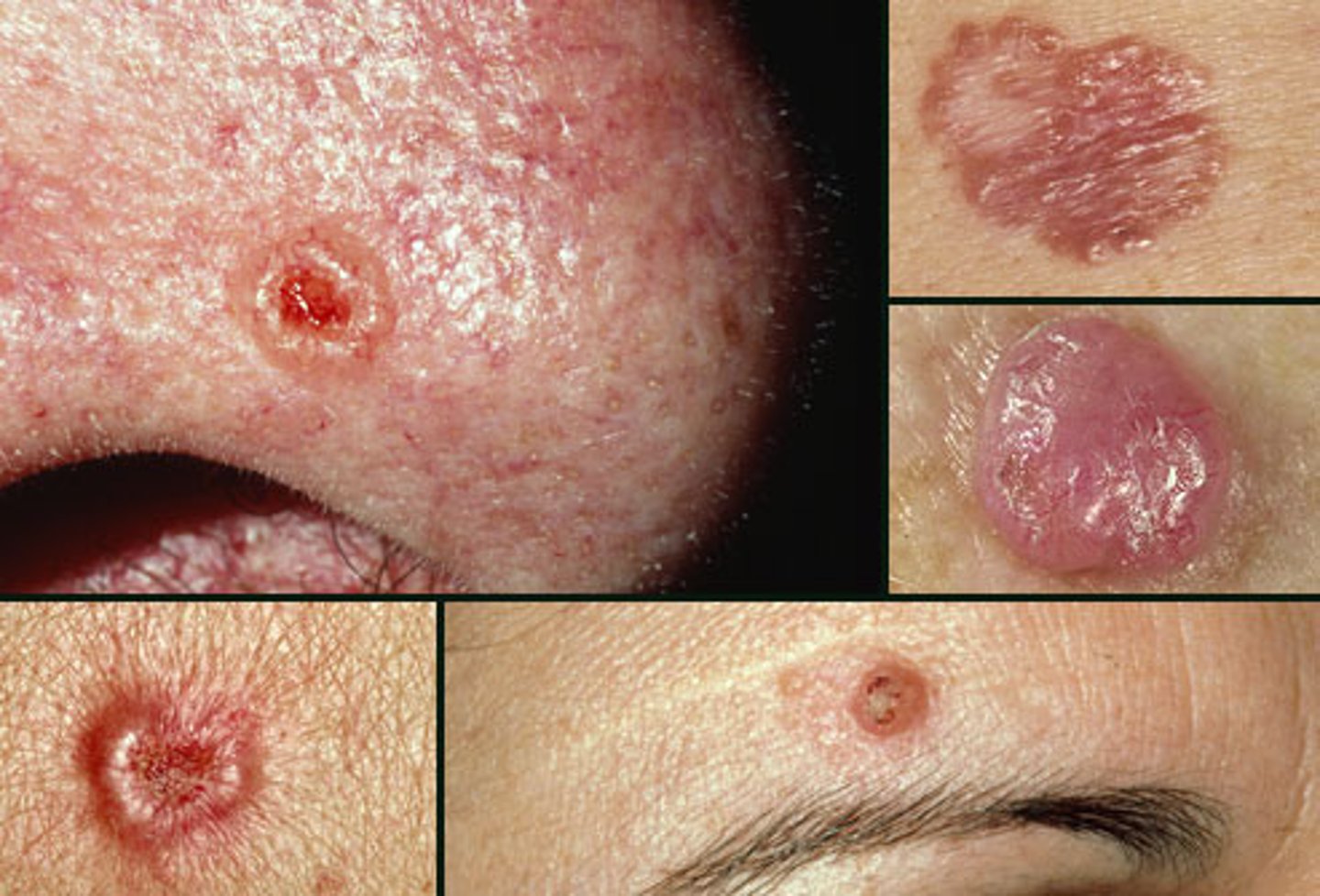 <p>Basal cell carcinoma</p><ul><li><p>Associated with <strong>intense intermittent UVR</strong></p></li></ul><p>Waxy, pink, pearly nodules. Commonly with telangiectasias &amp; rolled borders.</p>