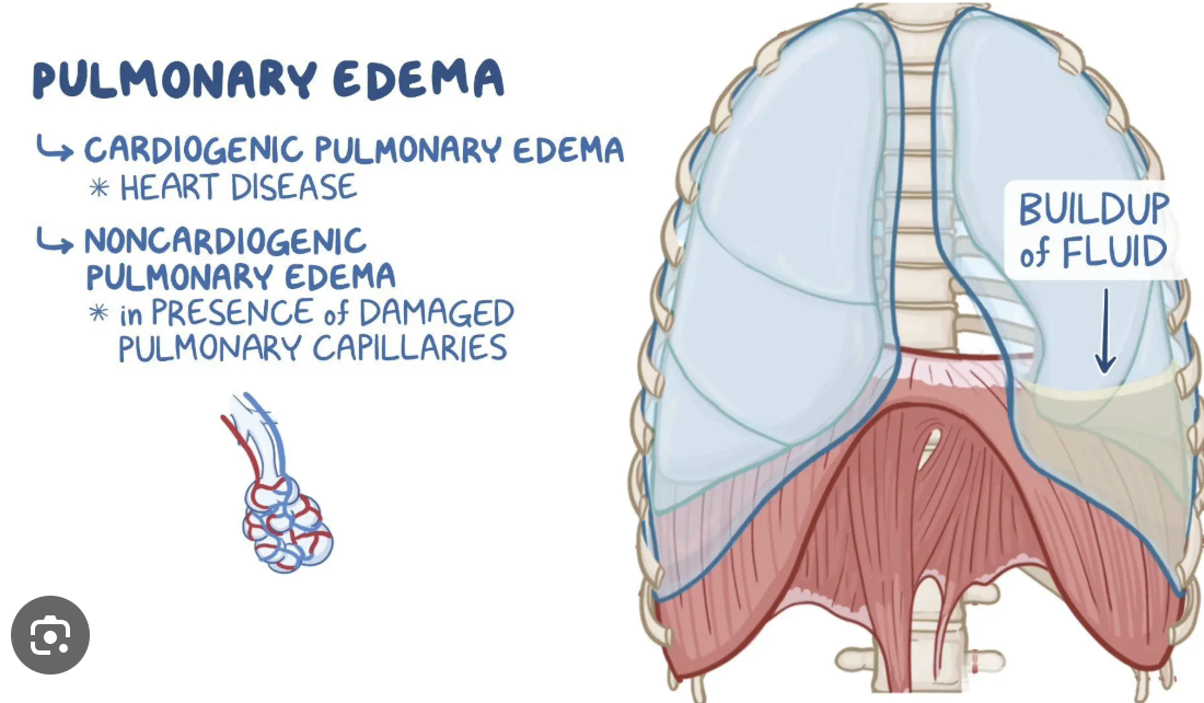 <ul><li><p><span style="background-color: transparent;"><strong>Pulmonary edema:</strong> Abnormal fluid accumulation in the lungs, occurring in the <strong>interstitial spaces and alveoli</strong>.</span></p></li><li><p><span style="background-color: transparent;">Two main types:</span></p><ol><li><p><span style="background-color: transparent;"><strong>Cardiogenic:</strong> Caused by heart dysfunction (e.g., acute MI, HF exacerbation).</span></p></li><li><p><span style="background-color: transparent;"><strong>Non-cardiogenic:</strong> Caused by other conditions (e.g., kidney failure, liver failure, oncologic fluid retention).</span></p></li></ol></li></ul><p></p>