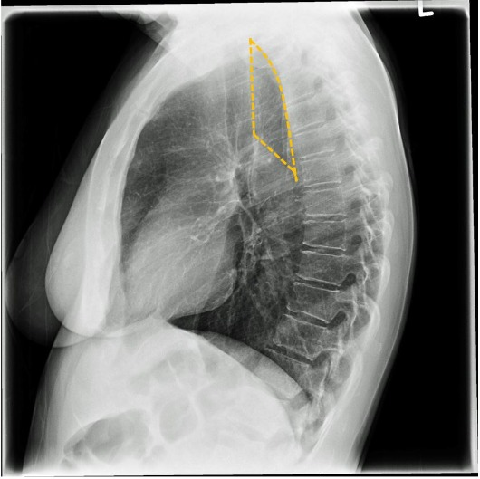<p><span>When the arms are inadequately abducted, this area will be obscured and can impact the patient's diagnosis.&nbsp;</span></p>