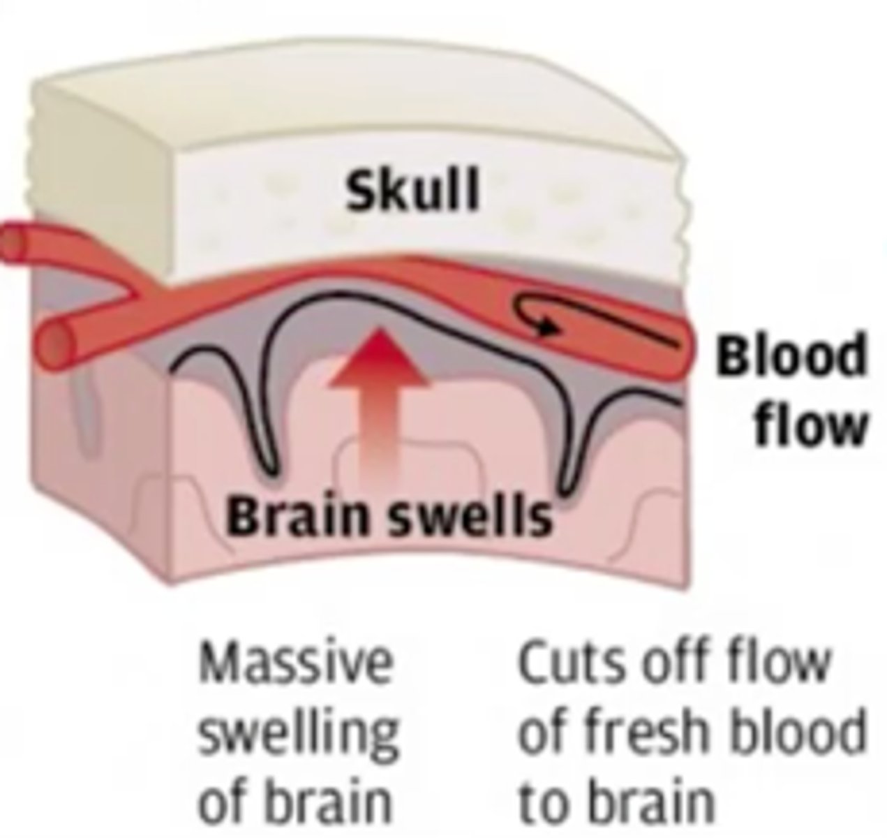 <p>exponential increase in symptoms from a concussion following the immature return of an athlete back into competition prior to symptoms being resolved</p><p>*brain may swell/herniate which can result in death</p>