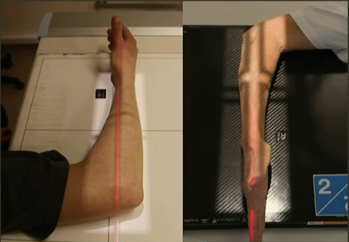 <p>Fine FS, 100cm</p><p>57kVp/2.5mAs</p><p>Straight tube</p><p>CR: midshaft radius/ulna</p>