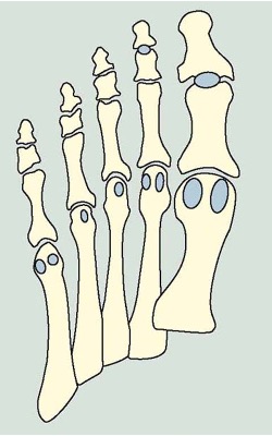 <p><span>twee plantair (gericht naar de voetzool) gelegen, goed te zien losse beentjes in het verlengde van een pees</span></p>