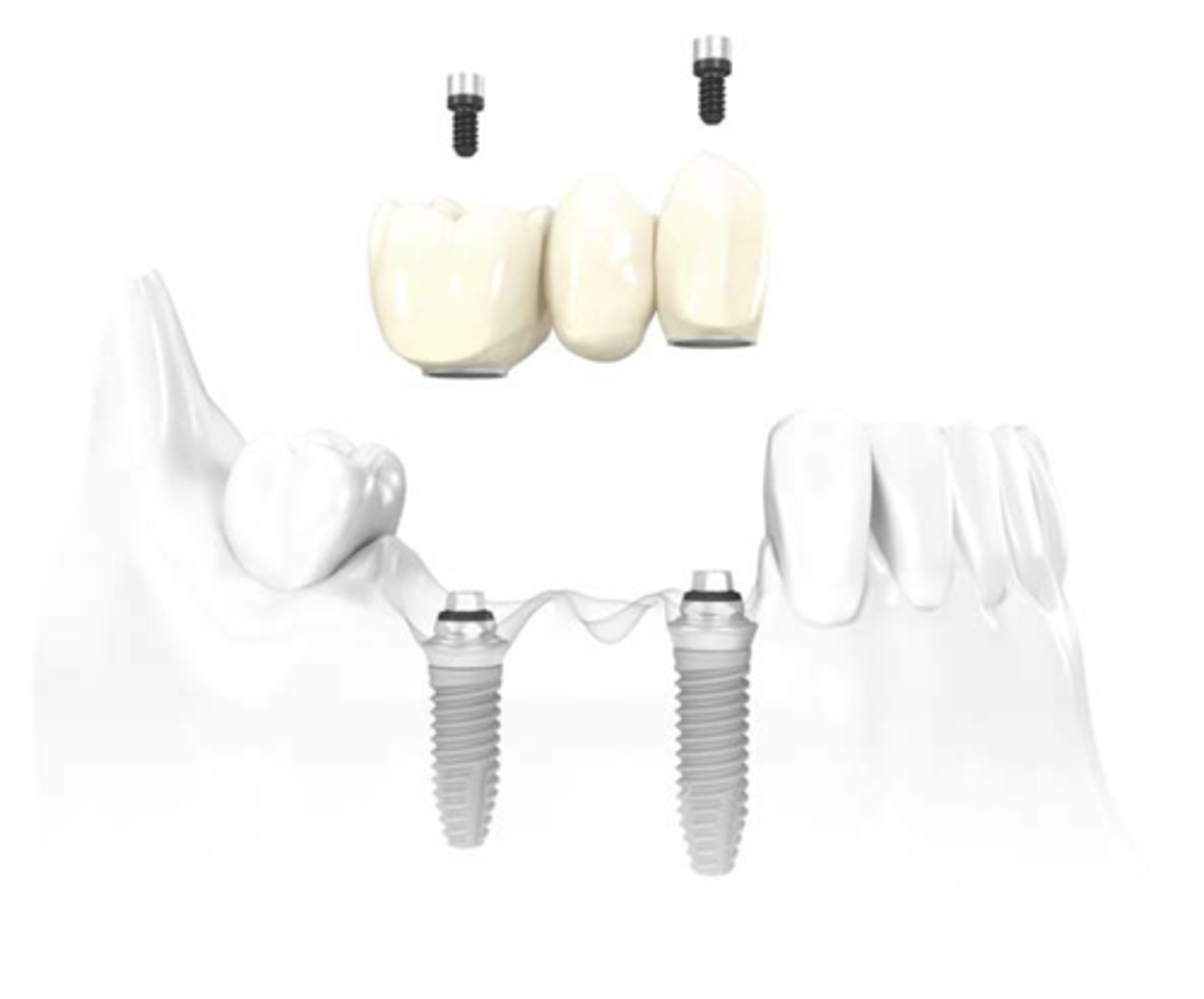 <p>ID the type of implant fixed partial denture:</p>