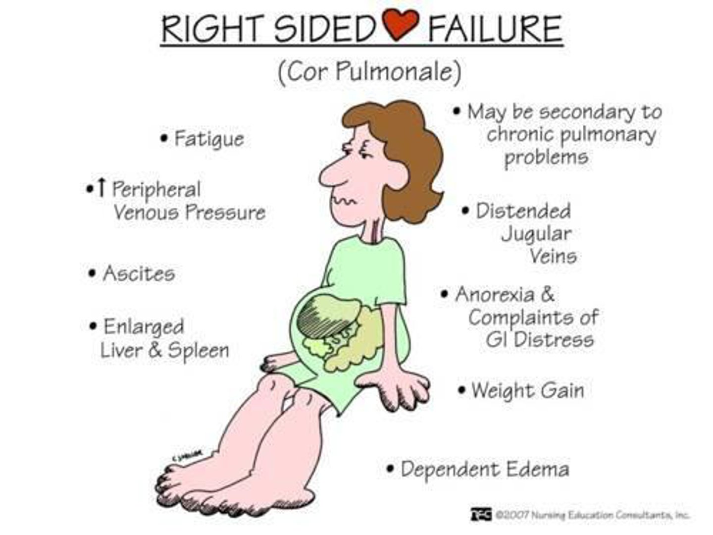 <p>the right ventricle fails</p><p>- less common</p><p>- right ventricle cannot accept or eject the returning blood from the periphery</p><p>- blood backs up in the periphery</p><p>- leads to increased pressure in the periphery and loss of fluids to tissues</p><p>- RAAS system is activated → peripheral edema</p>