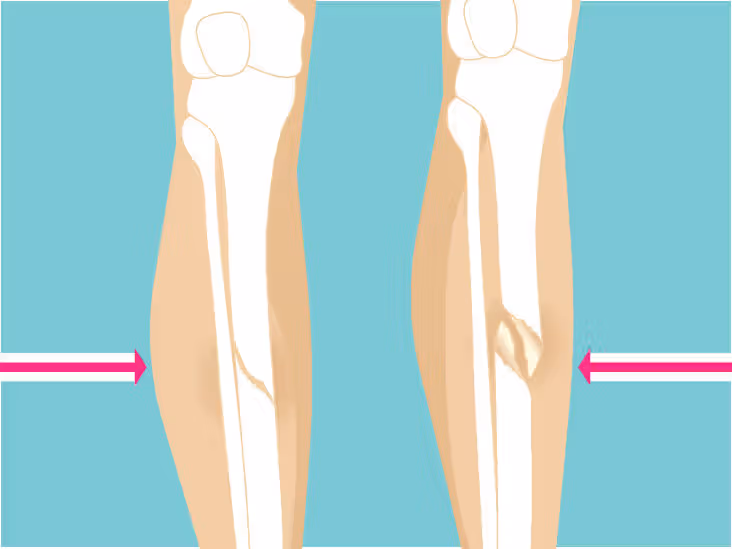 <ul><li><p>a fracture caused by a twisting or spinning force</p></li><li><p>causes a long, spiral-shaped break in the bone </p></li><li><p>sometimes the result of abuse in young children </p></li></ul><p></p>