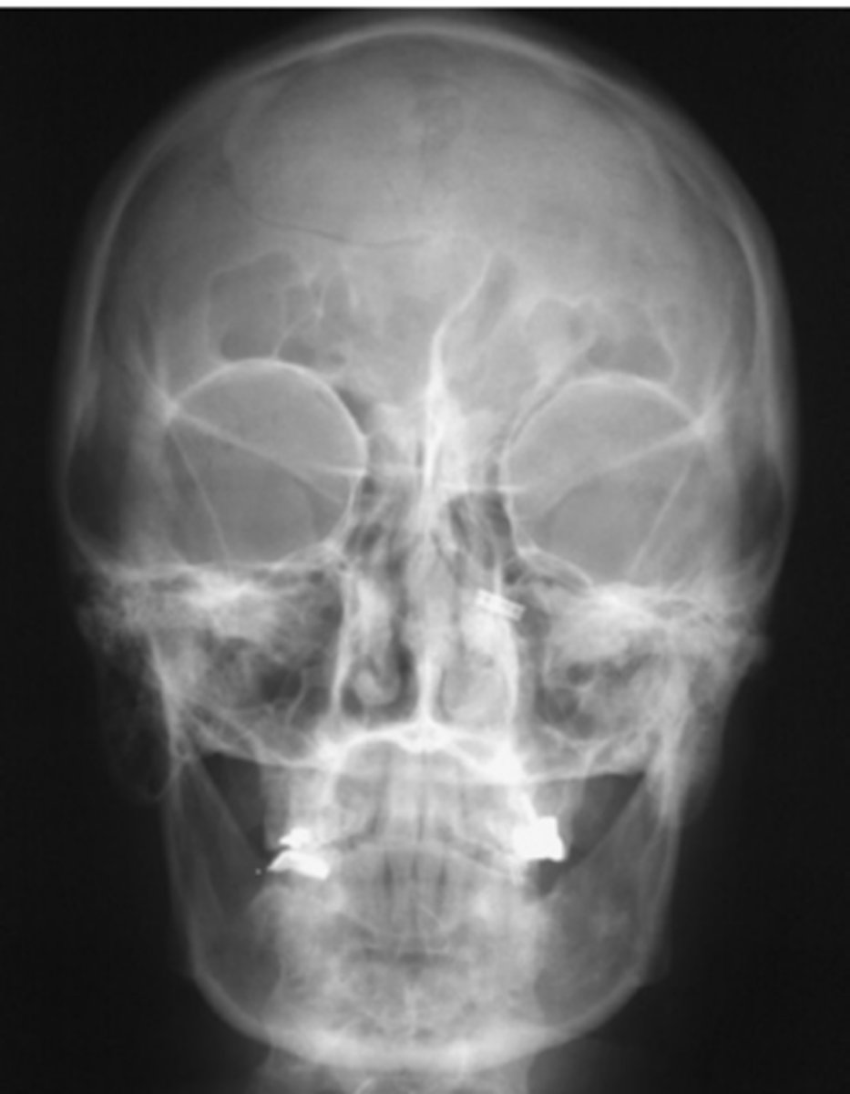 <p>-This is an AP 15° cephalad projection, as evidenced by the large size of the orbits resulting from magnification caused by increased OID</p><p>Repeatable errors (three)—</p><p>Criterion 2: Positioning </p><p>Criterion 3: Collimation and CR: The petrous ridges are not projected into the lower one-third of orbits. More flexion of neck or less CR angulation is required. The skull also is slightly rotated (note distance between orbits and lateral margins of skull) and tilted. </p><p>Criterion 5: Anatomic side markers: Anatomic side marker is missing.</p>