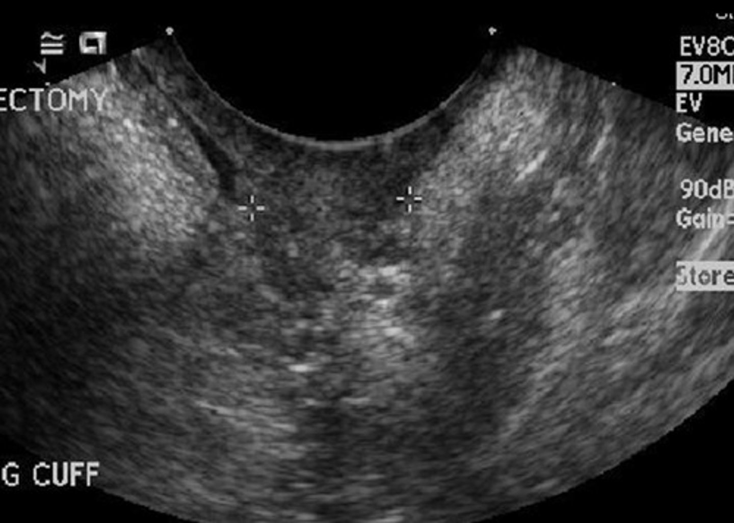 <p>Remnant from hysterectomy</p><p>Suture from anterior to posterior edges of vagina</p><p>Thin, hyperechoic</p><p>Some color flow normal</p>